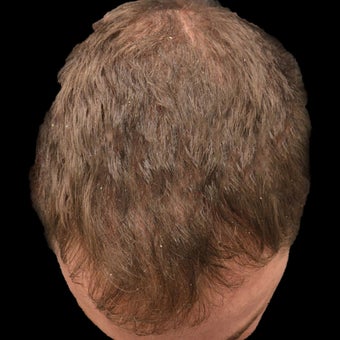 25-34 year old man treated with Hair Loss Treatment before 1736158