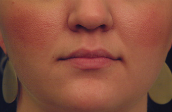 Restylane before 82765