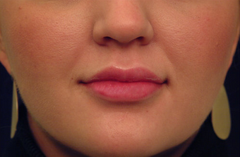 Restylane after 82765