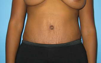 BeverlyHills Tummy Tuck after 659625