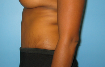 BeverlyHills Tummy Tuck 659625
