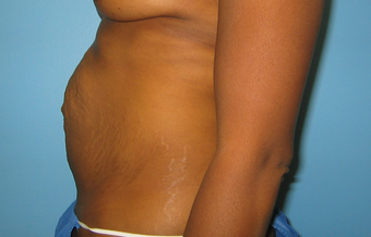 BeverlyHills Tummy Tuck 659625