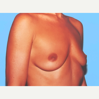 Breast Augmentation before 3732532