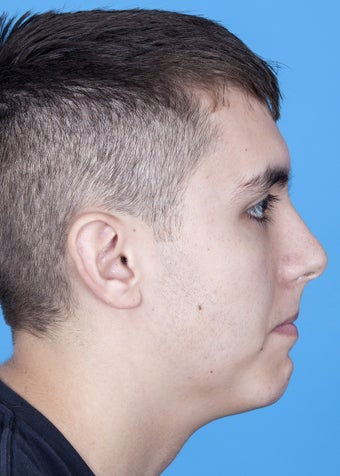 22 yo male with sleep apnea and microgenia, small chin after 1270733