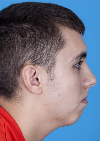 22 yo male with sleep apnea and microgenia, small chin before 1270733