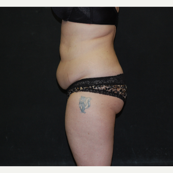 35-44 year old woman treated with Tummy Tuck before 3030837