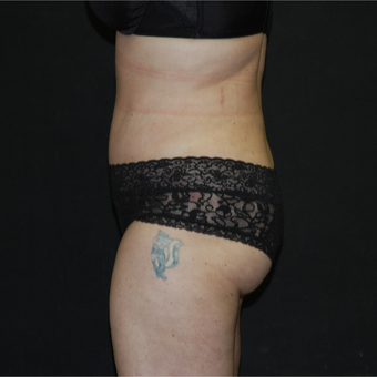35-44 year old woman treated with Tummy Tuck after 3030837