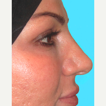 Rhinoplasty after 3814239