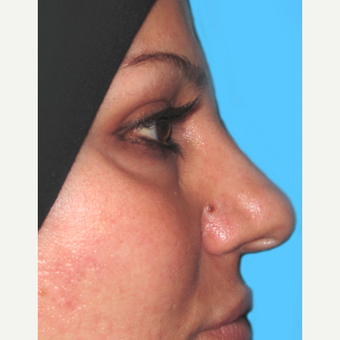 Rhinoplasty before 3814239