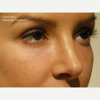 Non Surgical Blepharoplasty Young Woman after 2977509