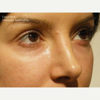 Non Surgical Blepharoplasty Young Woman before 2977509