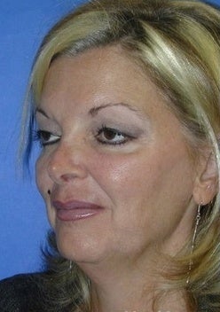 Face Lift for sagging and creases 1093873