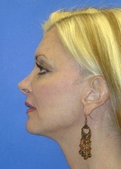 Face Lift for sagging and creases after 1093873