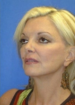 Face Lift for sagging and creases 1093873