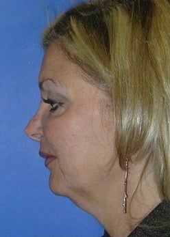 Face Lift for sagging and creases before 1093873