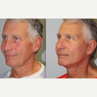 74 year old man treated with Neck Lift before 3263120