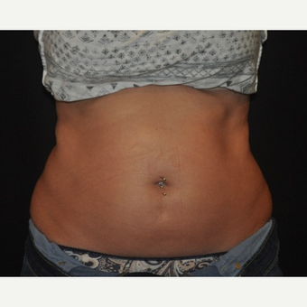 25-34 year old woman treated with CoolSculpting after 3476824