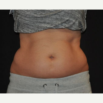 25-34 year old woman treated with CoolSculpting before 3476824