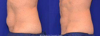 CoolSculpting to Lower Belly Fat before 1412883
