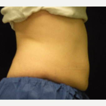 35-44 year old woman treated with CoolSculpting after 3679857