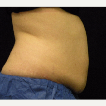 35-44 year old woman treated with CoolSculpting before 3679857