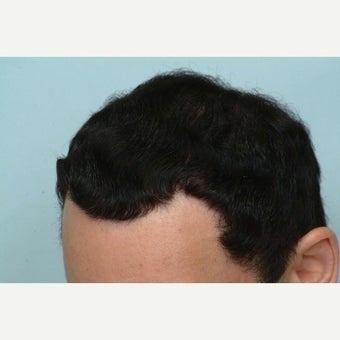 FUE Hair Transplant - 2500 grafts 1649870