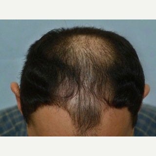 FUE Hair Transplant - 2500 grafts before 1649870