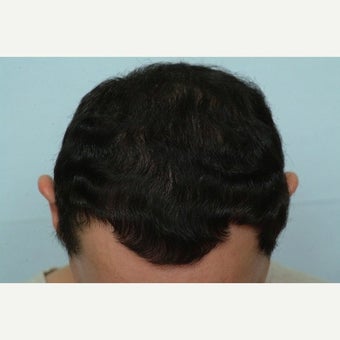 FUE Hair Transplant - 2500 grafts after 1649870