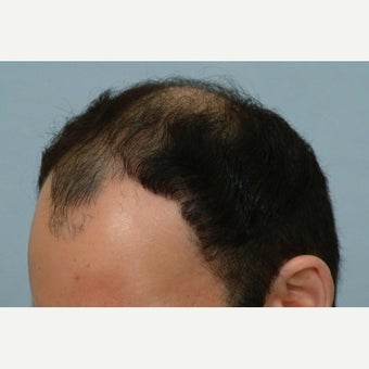 FUE Hair Transplant - 2500 grafts 1649870