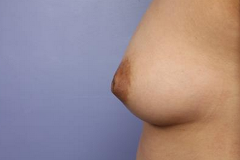 25-34 year old woman treated with Nipple Surgery before 1677426