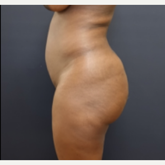 35-44 year old woman treated with Fat Transfer before 3200948