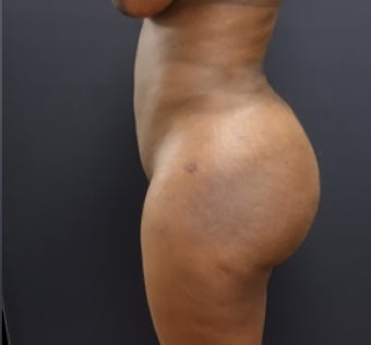 35-44 year old woman treated with Fat Transfer after 3200948