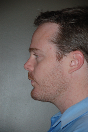 Chin Augmentation after 224645