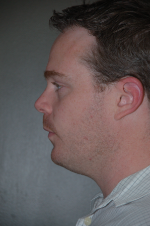 Chin Augmentation before 224645