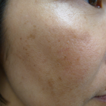 Asian skin type treated with lasers before 2941901