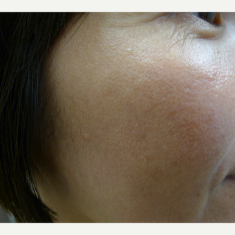 Asian skin type treated with lasers after 2941901