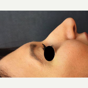 25-34 year old woman treated with Rhinoplasty before 3211363