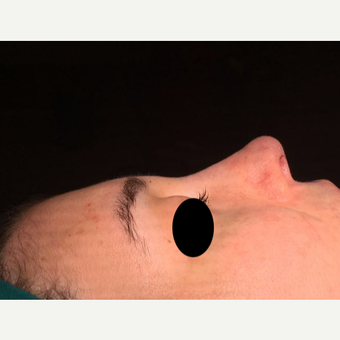 25-34 year old woman treated with Rhinoplasty after 3211363