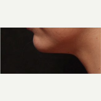 25-34 year old woman treated with Kybella followed by Ulthera to submental area 2 months after 2749651