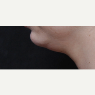 25-34 year old woman treated with Kybella followed by Ulthera to submental area 2 months before 2749651