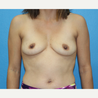25-34 year old woman treated with Breast Augmentation before 3091019
