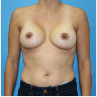 25-34 year old woman treated with Breast Augmentation after 3091019