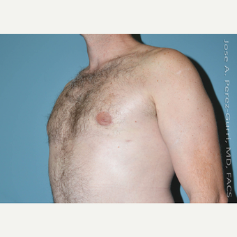 35-44 year old man treated with Male Breast Reduction after 3060172