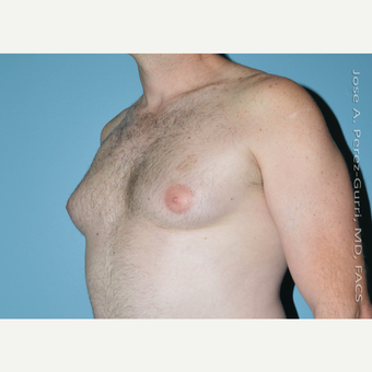 35-44 year old man treated with Male Breast Reduction before 3060172