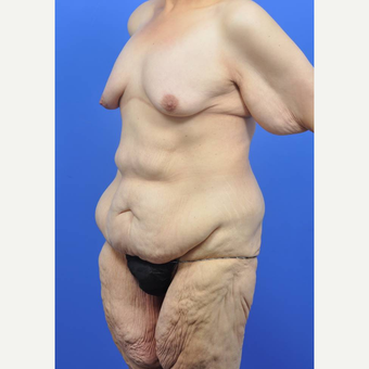 35-44 year old woman treated with Body Lift before 3450552