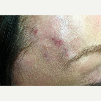 55-64 year old woman for prominent right temporal vein. after 3153053
