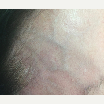 55-64 year old woman for prominent right temporal vein. before 3153053