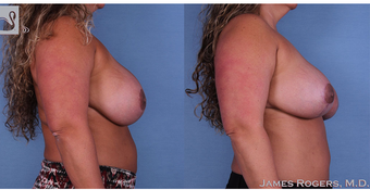 35-44 year old woman treated with Breast Implant Revision after 3844247