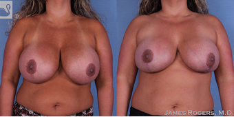35-44 year old woman treated with Breast Implant Revision before 3844247