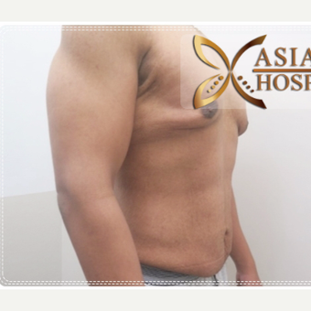 18-24 year old man treated with Total Abdominoplasty and Chest Surgery before 3649102
